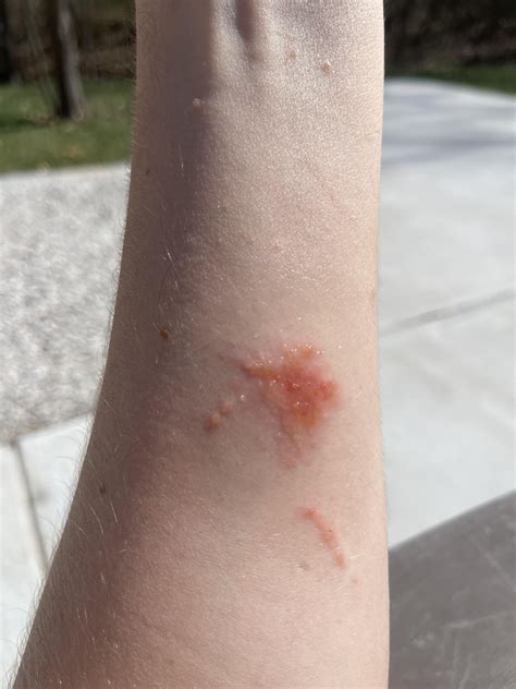 Does this look like scabies? It seems to be spreading : r/scabies