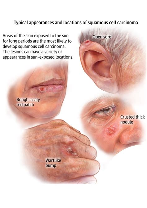 Basal Cell Carcinoma Rolled Border at Patrice Hassinger blog