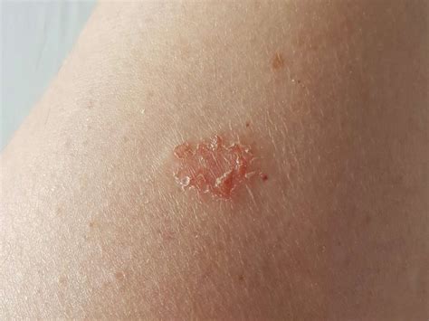 Causes and Treatments for Discoid Eczema Patches