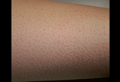 Xerosis - Eczema Free Skin