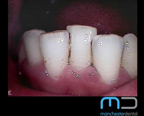 Stain Removal - Manchester Dental
