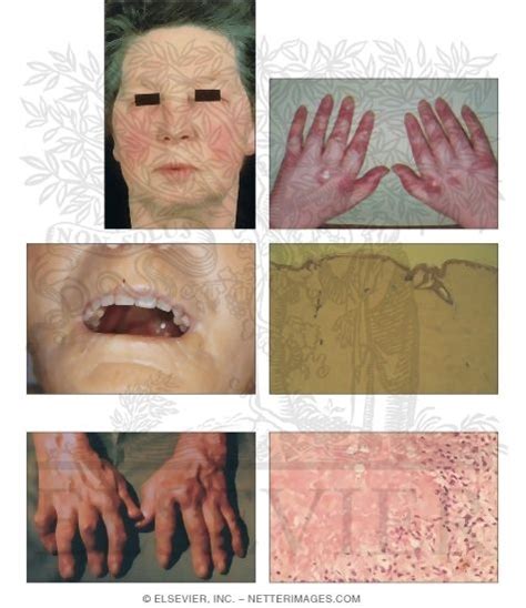 Collagen-Vascular Disease