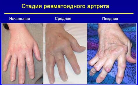 Ревматоидный Артрит - симптомы, лечение, диагностика