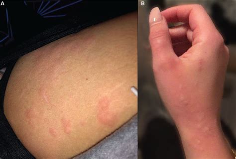 Common skin signs of COVID-19 in adults: An update | Cleveland Clinic ...
