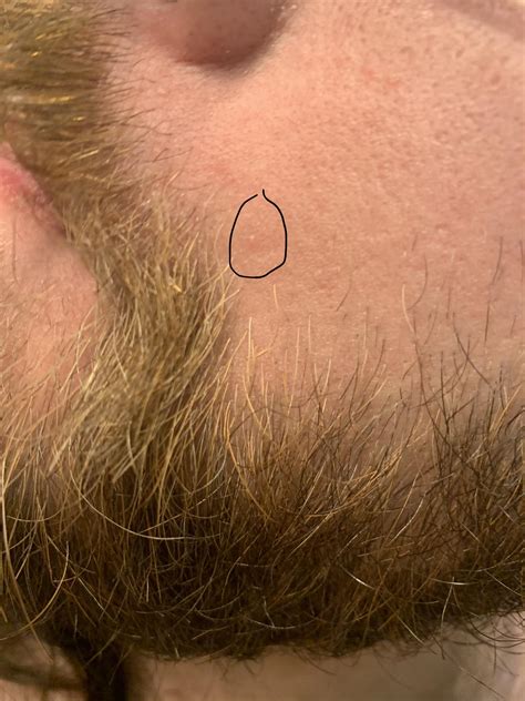 What is this raised bump is it a wart I had it cryotherapy twice or is