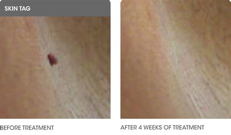 Skin Tags Removal in Richmond for Flawless skin lesions