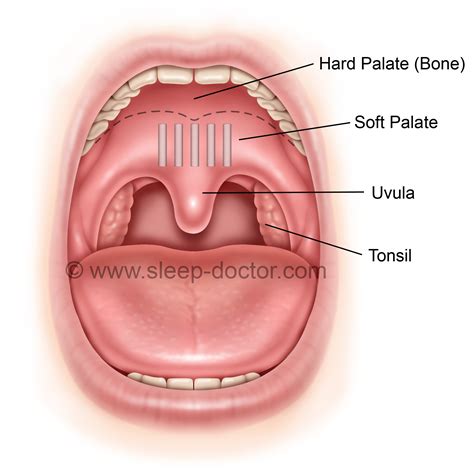 Choosing the Best Palate Surgery for Snoring | Sleep Doctor
