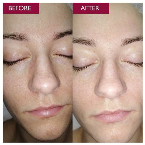 glycolic acid peel rosacea  matthew alvarez blog