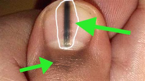 Share this information - If You See a Black Line On a Person’s ...