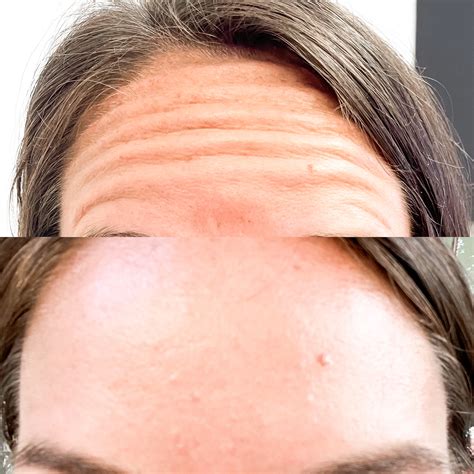 Botox in Lebanon, TN | Restoration Wellness