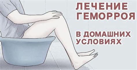 ТОП 10: лечение внутреннего геморроя народными средствами