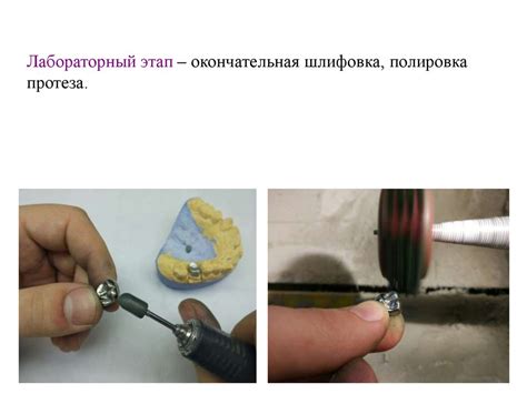 Искусственные коронки. Штампованная и цельнолитая металлические коронки ...