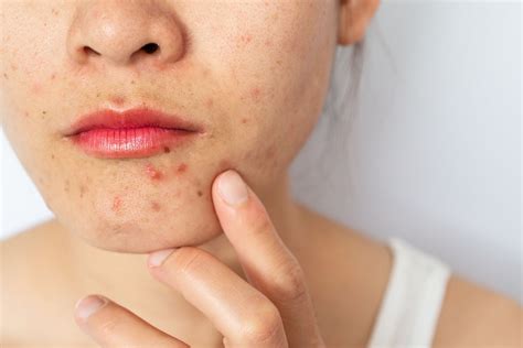 Hormonal Acne: What You Should Know, 41% OFF