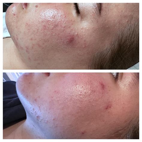 YAG Laser Treatments - Eleni London - Battersea Skin Clinic