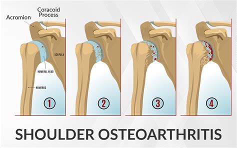 Shoulder Osteoarthritis - Dr. Saurabh Aggarwal