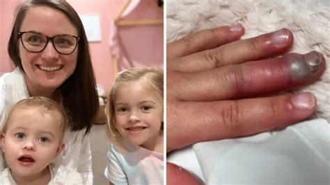 Bebê Com Dedo Inchado E Vermelho - Menina, de 4 anos, quase perde a visão e o dedo no parquinho: 'Pode ...