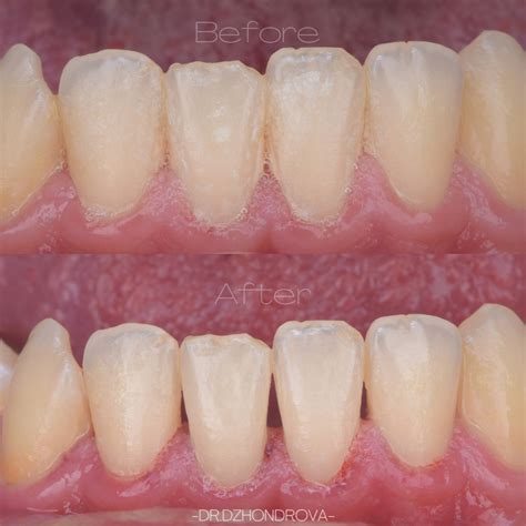 Гингивит - Симптоми, Лечение - Virtue Dental Center