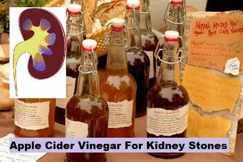 how much apple cider vinegar to drink for kidney stones