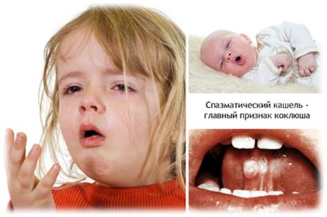 Профилактика коклюша