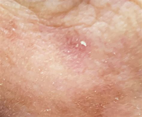 Mga Palatandaan at Larawan ng Babala ng Actinic Keratosis