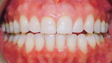class  malocclusion anterior open bite dental spacin vrogueco