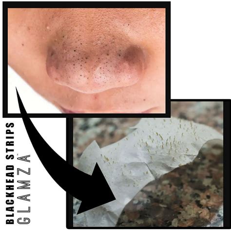 The Surprising Truth About Unbelievable Blackhead Removal 2024. Image 14