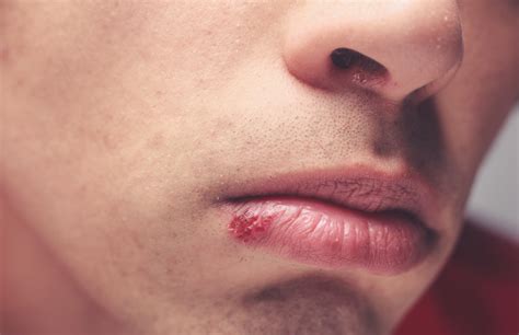Cold sore symptoms and cold sore treatment | Simple Online Doctor