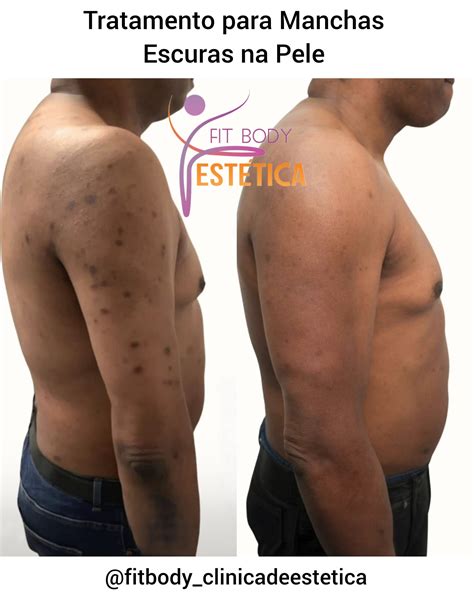 Manchas Escuras Na Barriga Homem - Tratamento para Manchas Escuras na Pele-Dra.Sacha Silveira