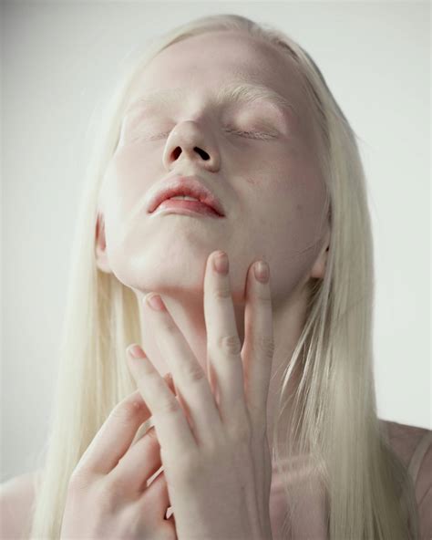 How to distinguish vitiligo from partial albinism?