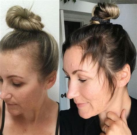 Is PRP for Hair Loss Effective? A Detailed Guide - The Hair Stylish
