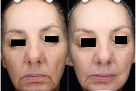 BBL Photofacial in North Myrtle Beach | Touch MedSpa