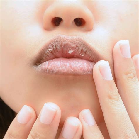 Crusty Lips