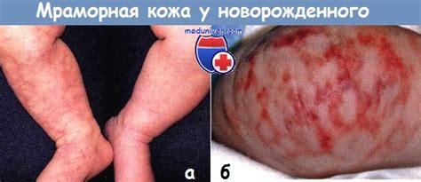 Врожденная мраморная телеангиэктатическая кожа (CMTC) у новорожденного