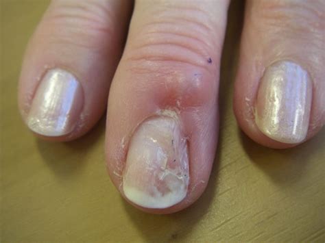 Nail Bed Injuries Treatment | Sydney Orthopaedic Surgeon