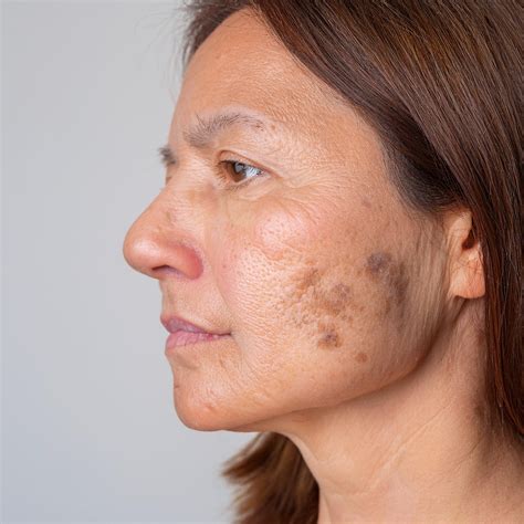 O Que É Melasma No Rosto - Melasma no Rosto: Guia Completo de Causas, Tratamentos e Prevenção ...