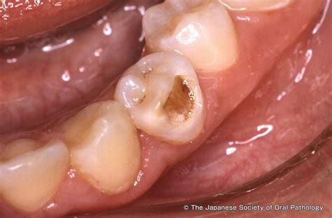 Turner's Teeth at Lavina Flippen blog