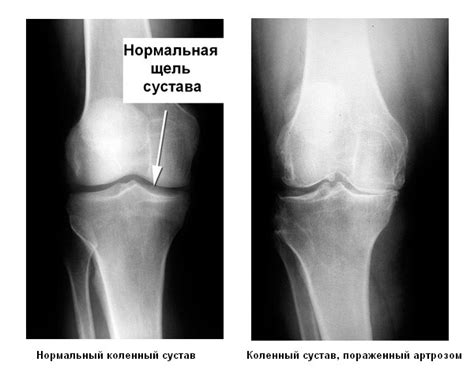 Рентген коленного сустава: как выглядит сустав в норме и при патологии