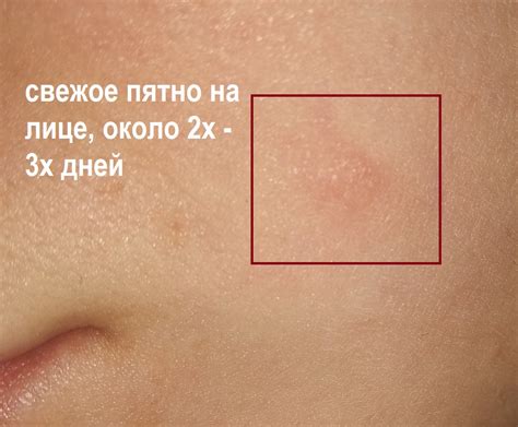 Белые пятна На лице странные шершавые белые пятна. похоже на лишай. что ...