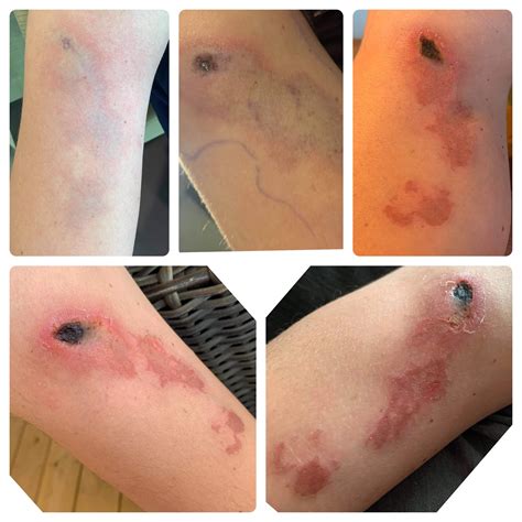 Brown Recluse Spider Bite Stages