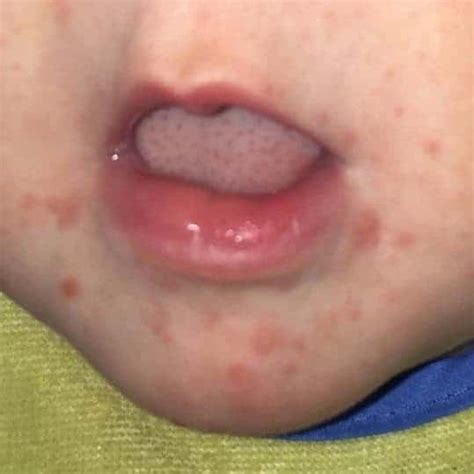 Red Spots On Lips Toddler | Lipstutorial.org