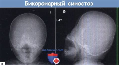 Брахицефалия - методы диагностики, лечения по Европейским рекомендациям