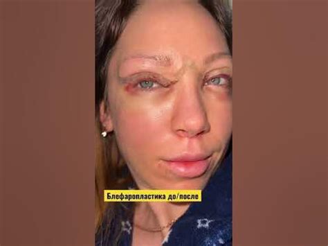 блефаропластика, результат в конце #блефаропластика - YouTube