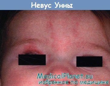 Сосудистые мальформации. Невус Унны.