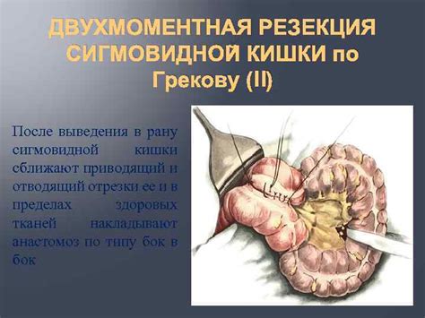 ОПЕРАЦИИ НА ТОЛСТОЙ КИШКЕ Кафедра ОКХТА 2014 г