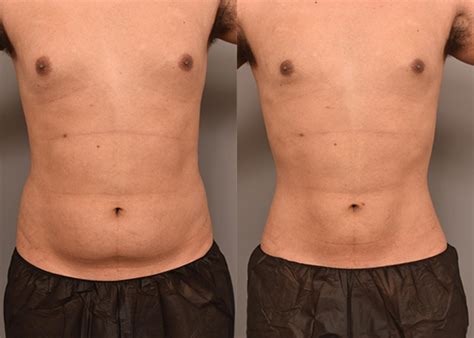 lipo  case