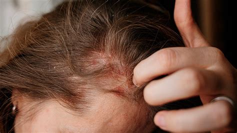 Mild Psoriasis: Pictures, Types, and Symptoms
