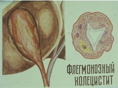 Острый холецистит – неспецифическое воспаление желчного пузыря - online ...