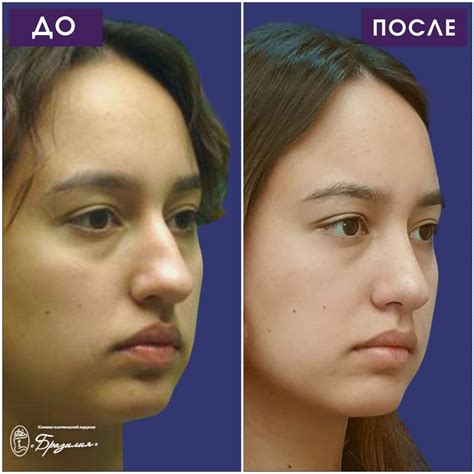 Ринопластика, пластика носа цена и отзывы в Калининграде