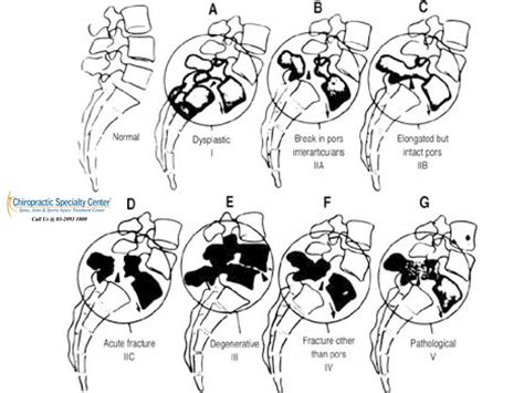 Spondylolisthesis and spondylosis