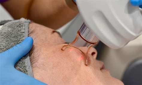 surgical  laser mole removal maitland newcastle nsw